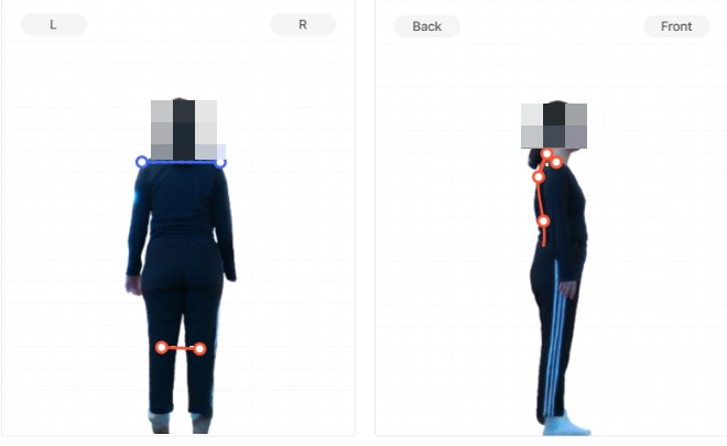 동탄 체형교정 후면·측면 — 어깨 수평 비대칭과 발목 정렬 체형측정 결과