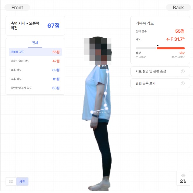 라운드숄더 어깨 체형측정 결과 동탄 내몸에미소