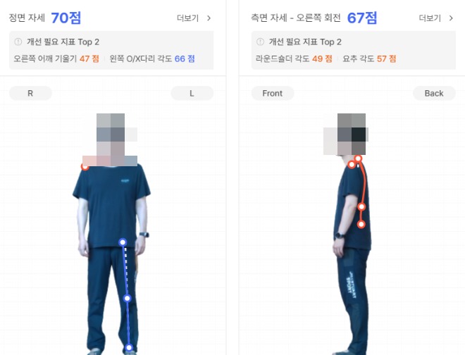 동탄 어깨통증 재활운동 자세 분석