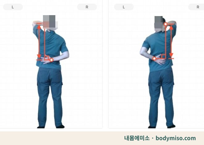 동탄 어깨통증 재활운동 옆으로 늘이기