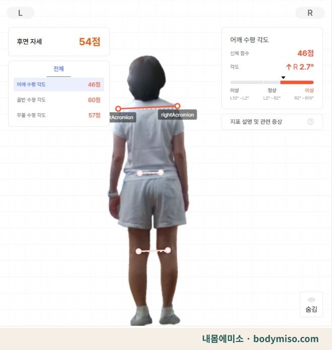 동탄 척추측만증 자세분석 어깨 균형 검사