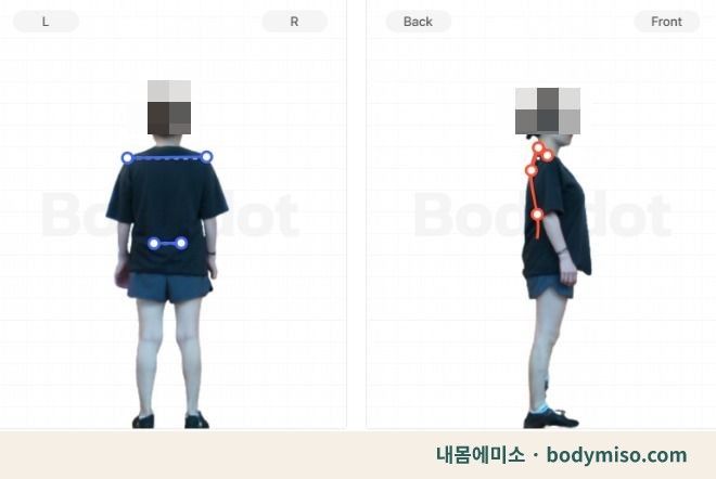 동탄 어깨허리 재활운동 자세교정