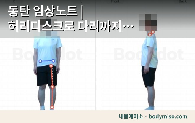 동탄 자세 교정 운동 허리 무릎 분석