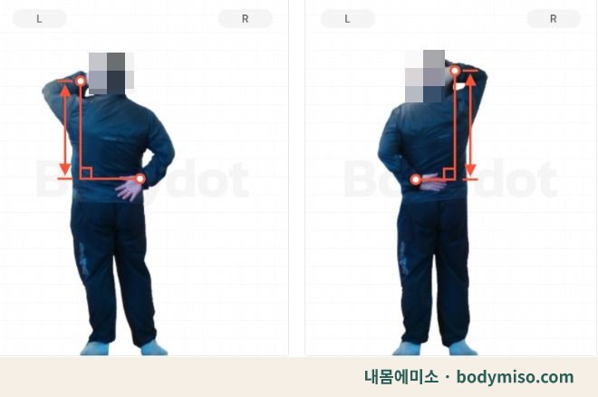 라운드숄더 각도 — 동탄 내몸에미소