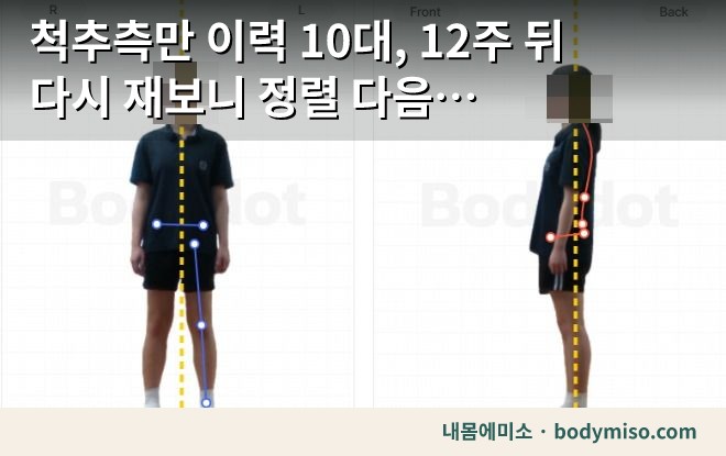 척추측만 이력 10대, 12주 뒤 다시 재보니 정렬 다음 과제가 보였습니다 — 동탄 내몸에미소